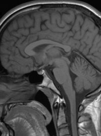 Magnetická rezonance hlavy člověka