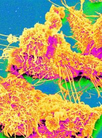 Obarvené buňky rakoviny prsu pod elektronovým mikroskopem